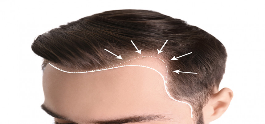 Boldenone and hair loss?